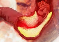 고지혈증 증상 1