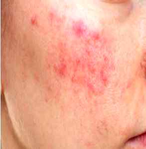 주사피부염 초기 증상: 잘못된 여드름 진단의 함정