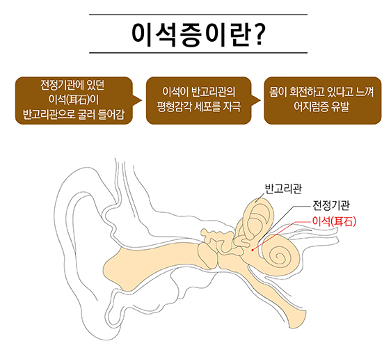 이석증 증상 및 치료법 최신 정보 알아보기