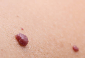 섬유종 관련 사진