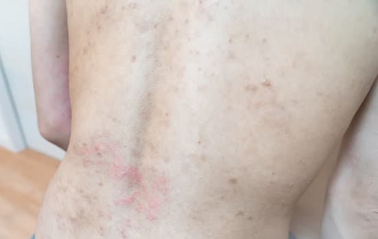 아토피에 대한 이해