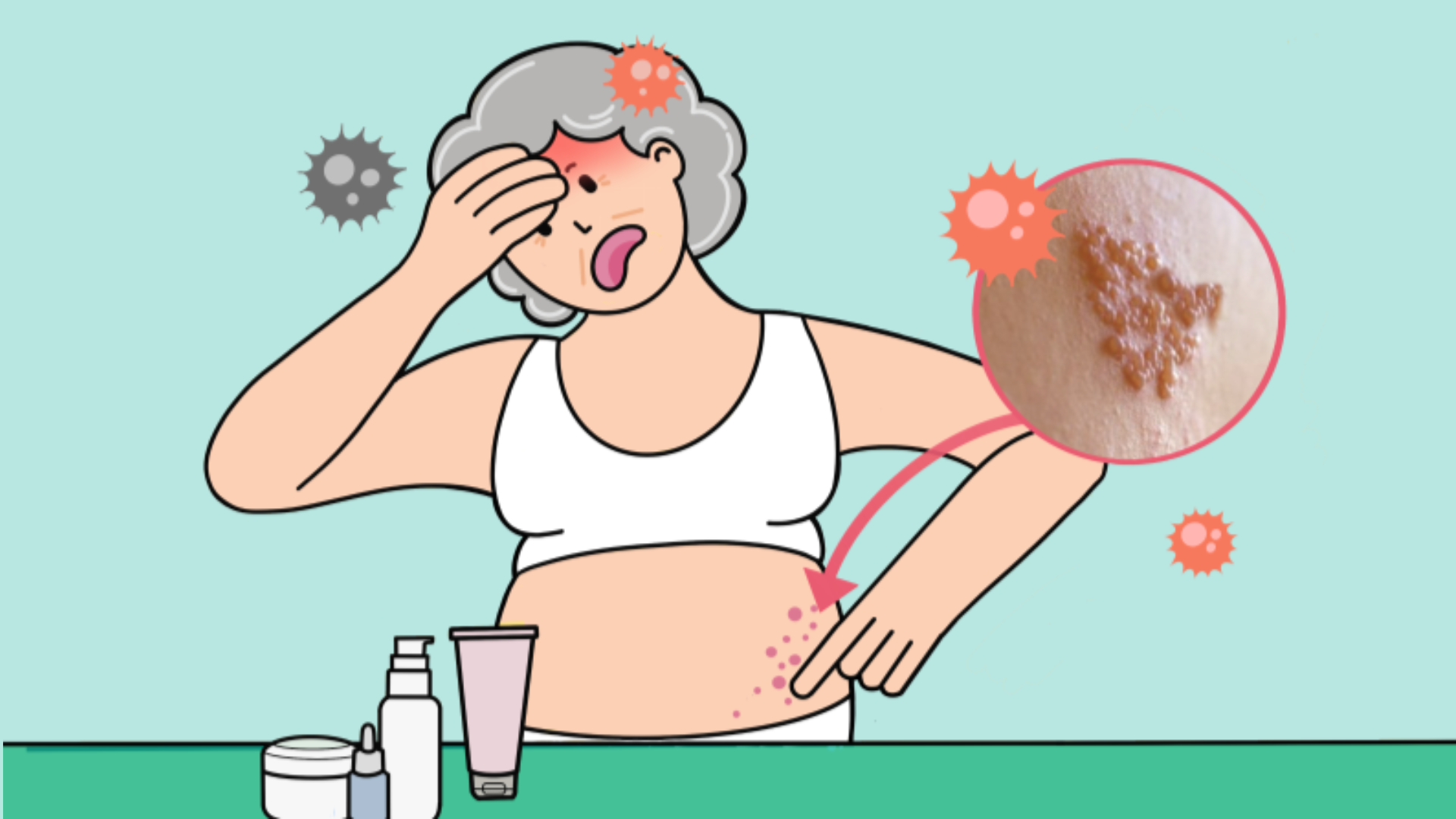 대상포진 전염성의 특징