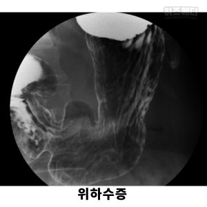 위하수증