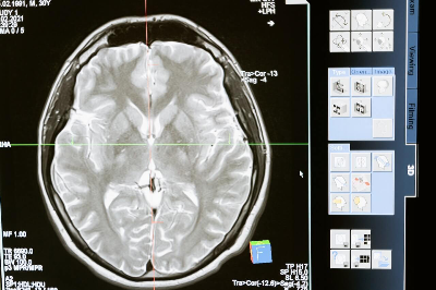 엑스레이 뇌 사진
