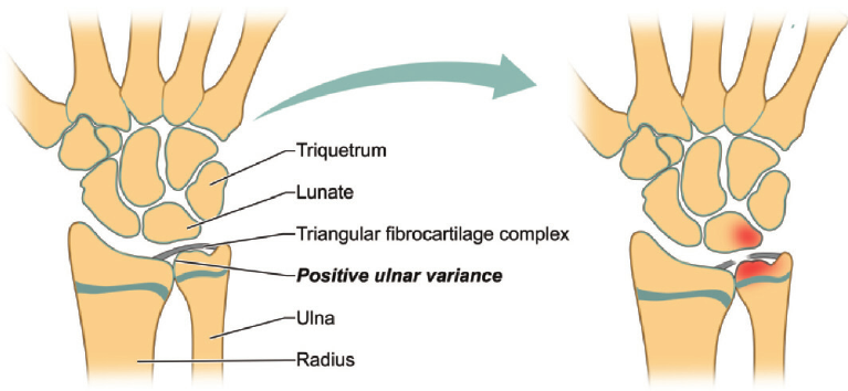ulnarimpingmentsyndrome-척골충돌증후군-삼각섬유연골