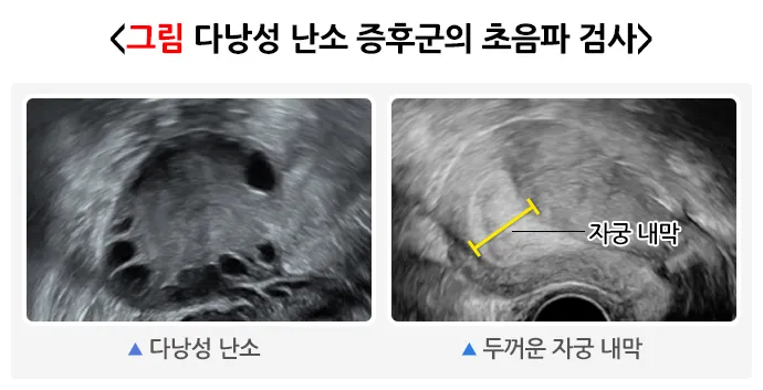 다낭성 난소증후군
