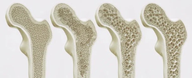 골밀도 검사 방법, 결과 정상수치, 골밀도 높이는 방법