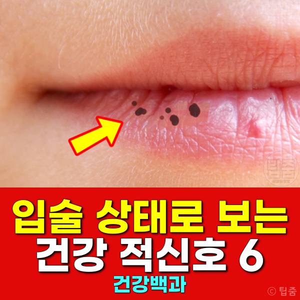 입술 건강 입가찢어짐 입술뾰루지 입술색변화 부은입술 입술검은점 윗입술주름