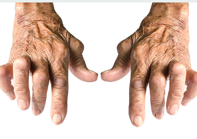 류마티스 관절염