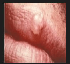 입술수포&amp;#44; 구순포진&amp;#44;헤르페스치료법&amp;#44; 예방까지