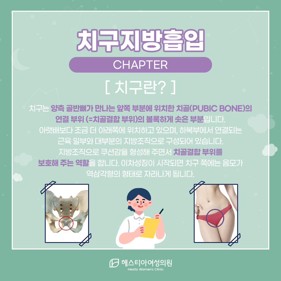 치구란?