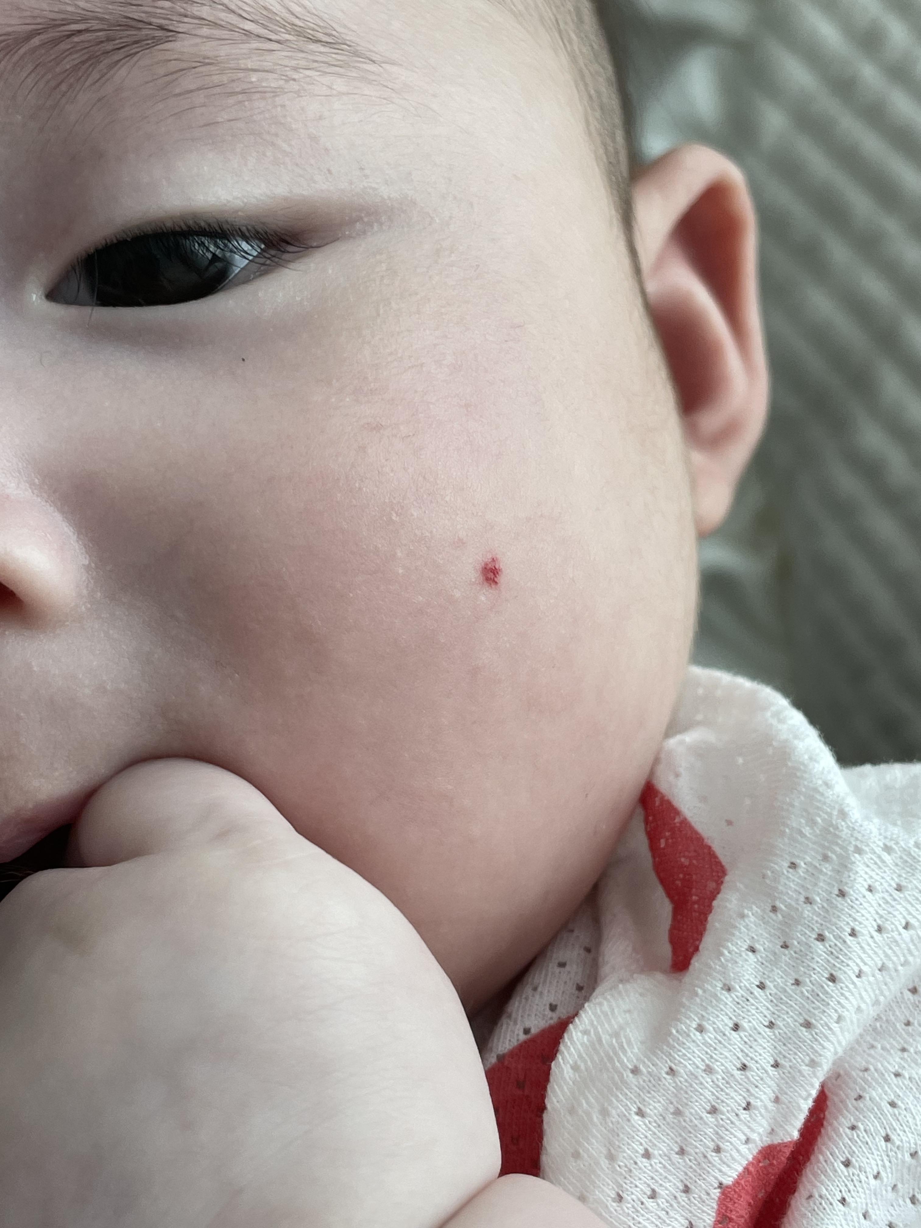 혈관종 에스앤유 피부과