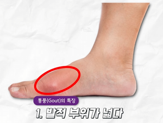 통풍1