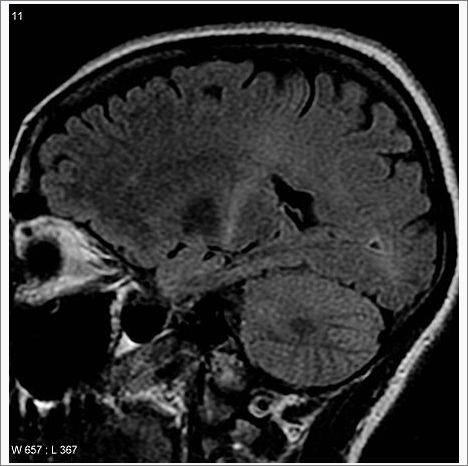 근위축성 측삭경화증(ALS)을 나타내고 있는 MRI 사진.