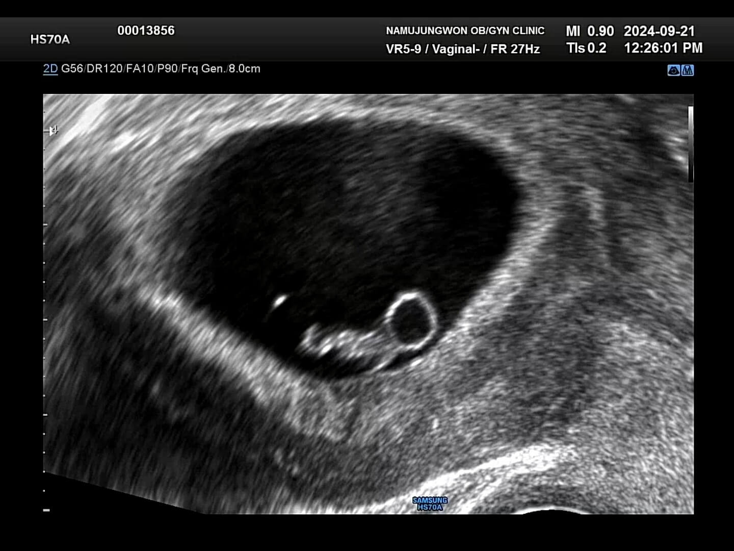 7주-초음파-사진
