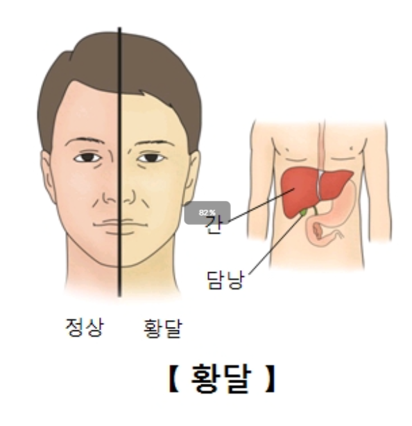 담도암 증상 및 진단 과정 