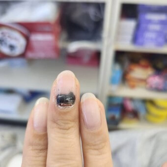 중지-손톱에-피멍이-들어-점점-빠지고-있는-모습