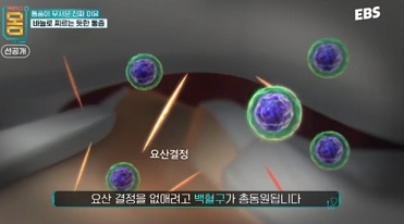 요산결정