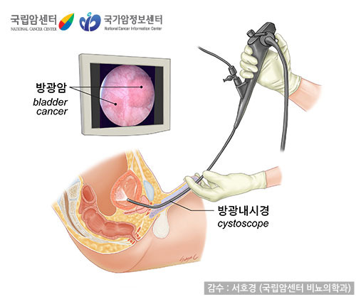 방광암 초기증상