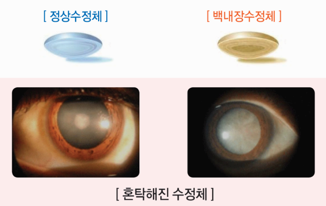 백내장 사진