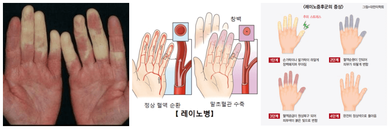 레이노 현상, 레이노 증후군 설명, 증상 사진