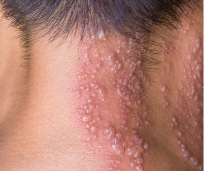 대상포진예방접종, 백신종류 비용