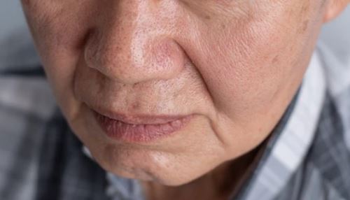 팔자주름 생기는 원인