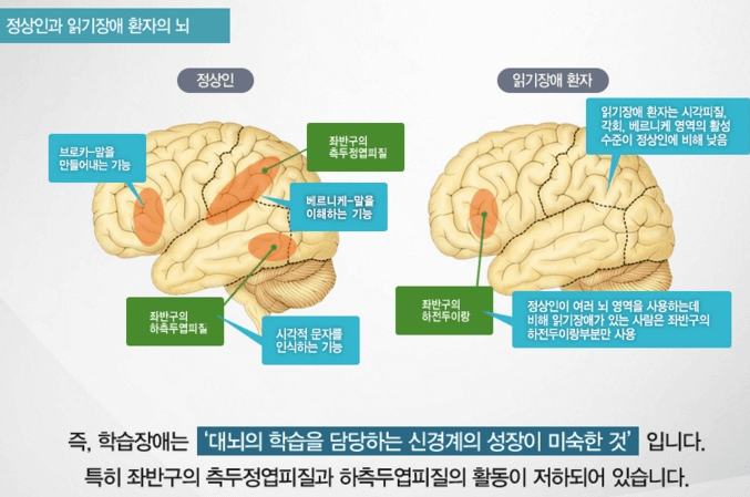 뇌의 베르니케 영역과 브로카 영역