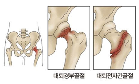 고관절구조
