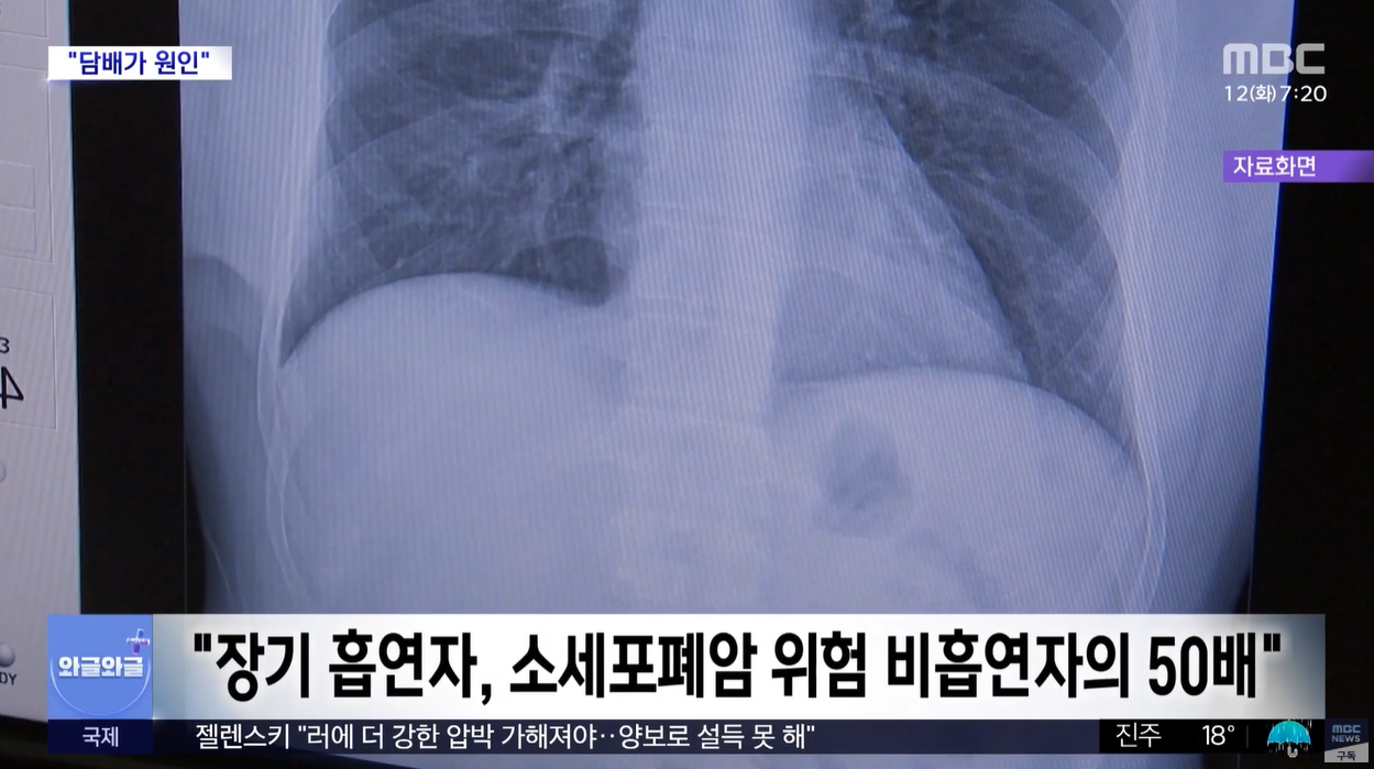 흡연과폐암 소세포폐아 흡연력 장기흡연 금연 건강보험공단
