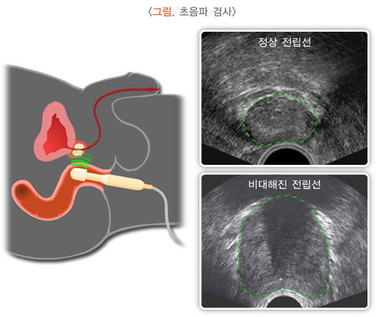 전립선 비대증에 좋은 대증요법