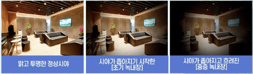 녹내장 시야