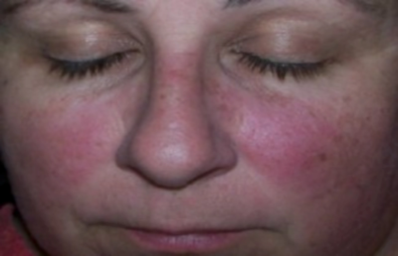 루푸스 증상 진단 검사 치료방법