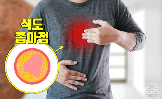 식도암 증상 식도암초기증상 음식 넘길때 통증