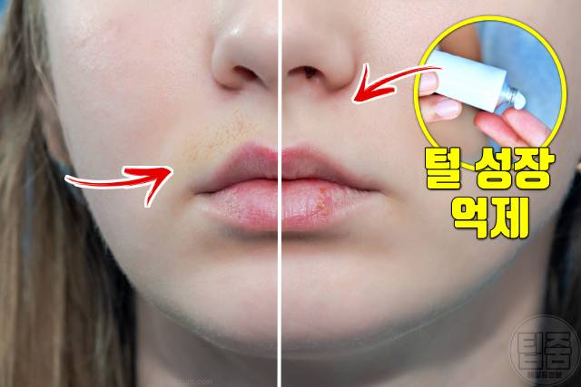 여자 인중 수염 없애는법 제모 없이 에플로르니틴