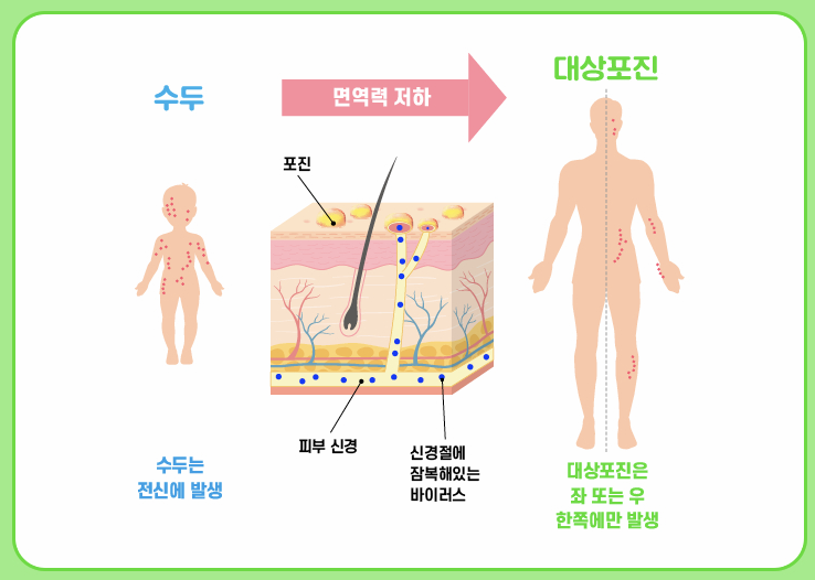 수두와 대상포진의 비교 이미지