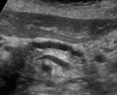 췌두부의 암 (Adenocarcinoma of head of pancreas)