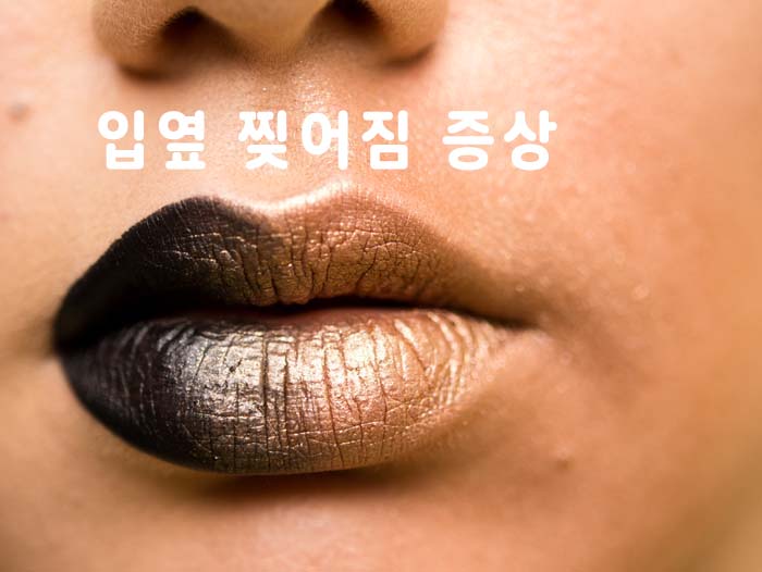 입옆 찢어짐 이미지 입니다.