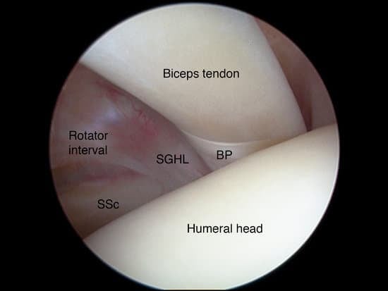 어깨 관절경 수술