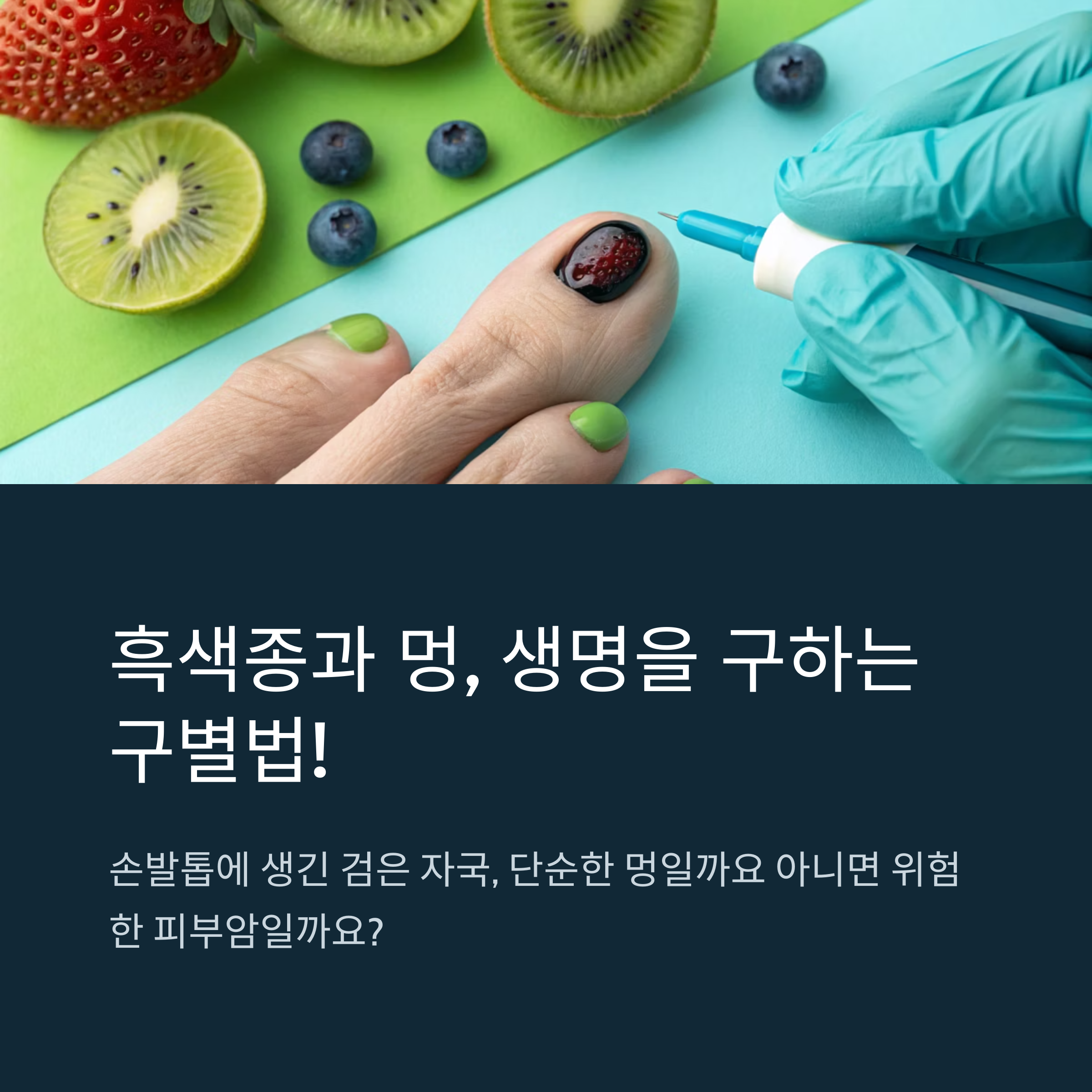흑색종과 멍