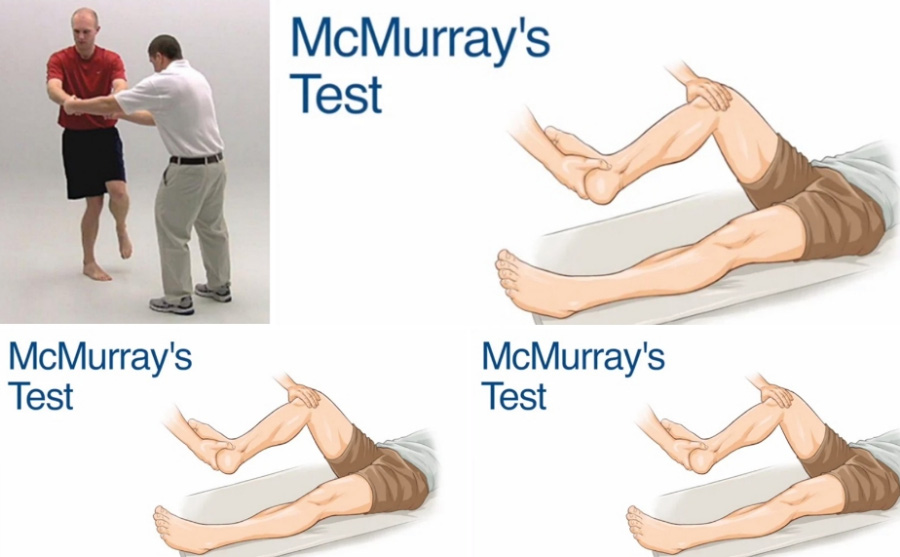 환자를 눕게 하여 다리를 들고 발목을 쥐고 회전을 시키며 반월판의 손상이 있는지를 판별하는 검사인 맥머레이 테스트의 방법을 자세히 그린 이미지 사진