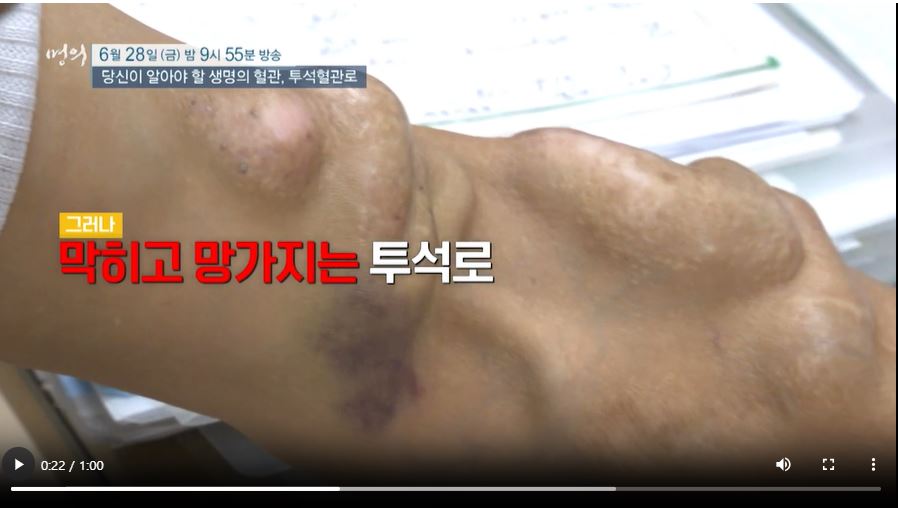 EBS 명의 혈액투석 투석혈관로