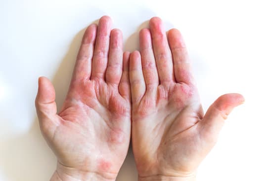 습진(Eczema): 원인, 증상, 치료 및 관리 방법