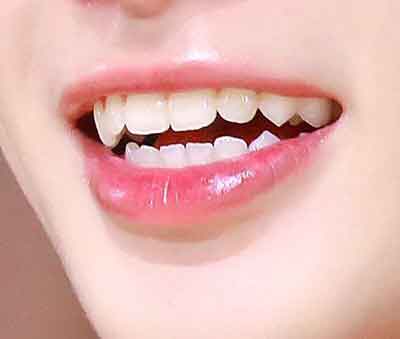 웃을때 인중 모양