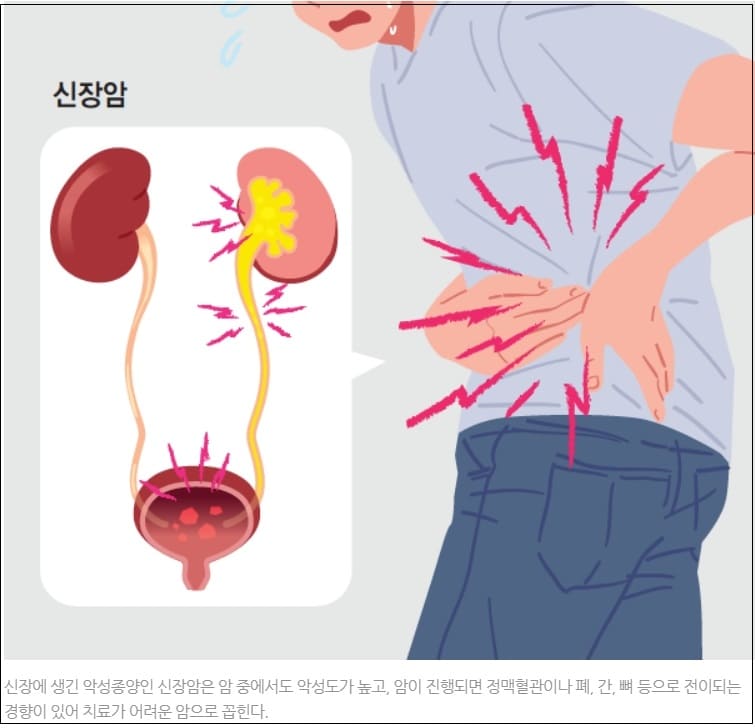 ‘착한 암’으로 불리는 이 암...요즘 왜 젊은 층에서 유난히 증가하나