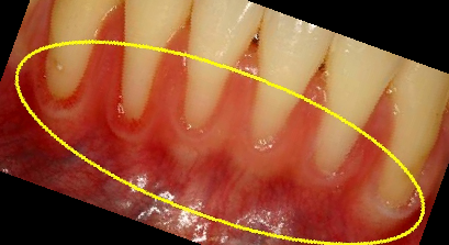 잇몸 내려앉음 치료