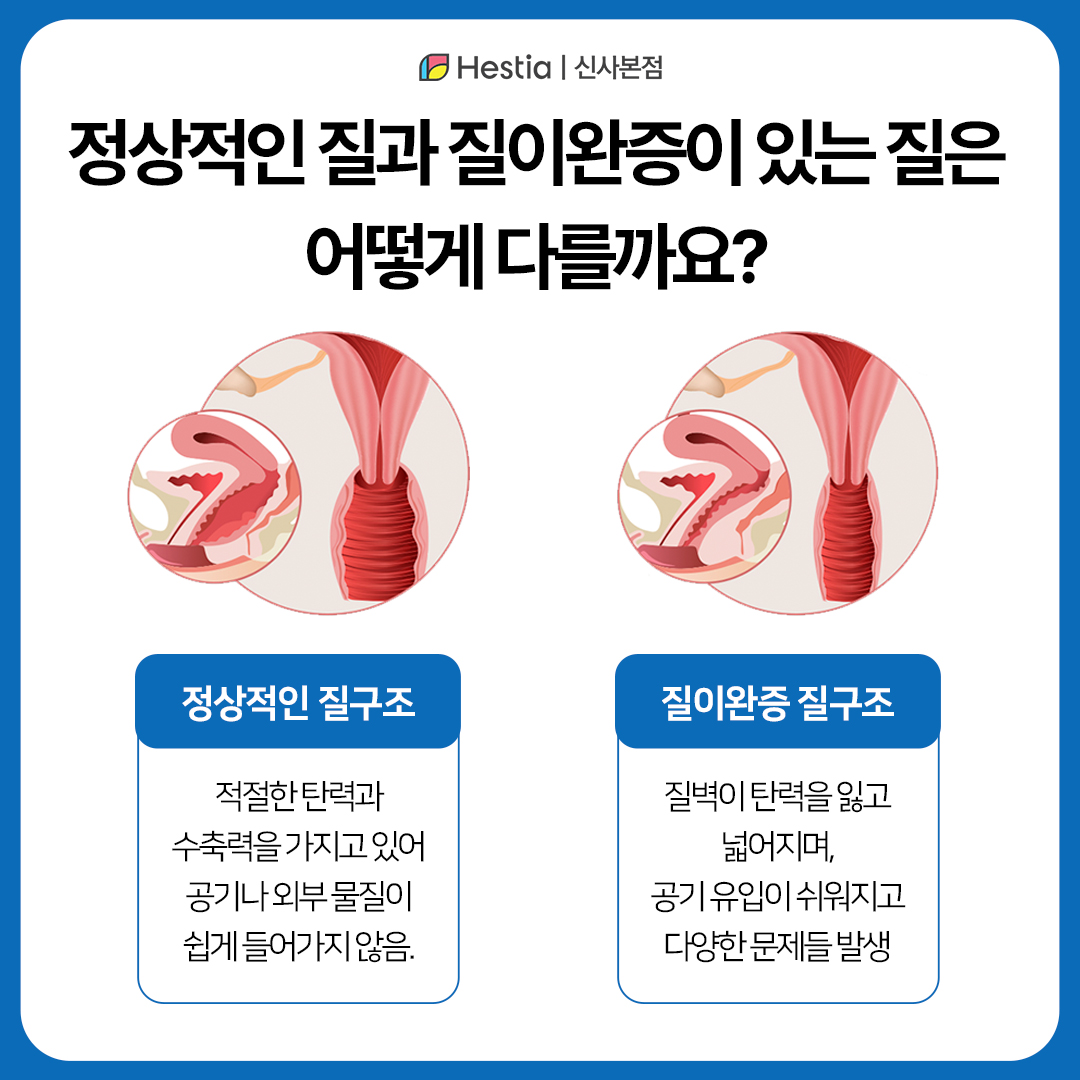 정상적인 질 구조 vs. 질이완증