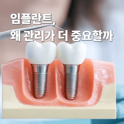 임플란트, 왜 관리가 더 중요할까