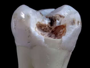 임플란트 시술과정 시술기간 시술 종류