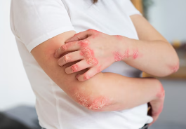 피부 붉은반점 22